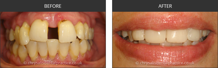 Gradia Smile Transformations at chrsalis dental practice, bedford dental practice