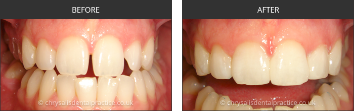 Gradia Smile Transformations at chrsalis dental practice, bedford dental practice