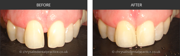 Gradia Smile Transformations at chrsalis dental practice, bedford dental practice