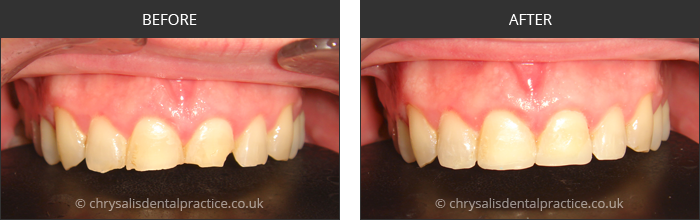 Gradia Smile Transformations at chrsalis dental practice, bedford dental practice