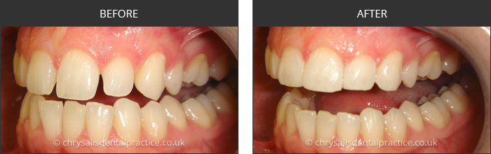 Gradia Smile Transformations at chrsalis dental practice, bedford dental practice