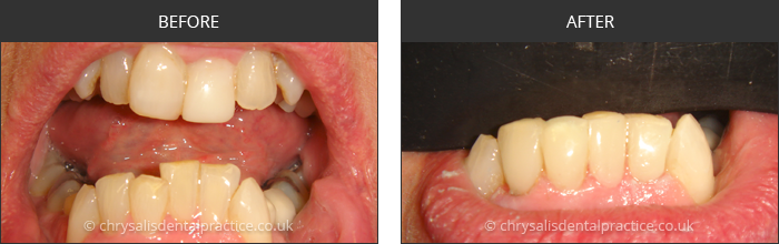 Gradia Smile Transformations at chrsalis dental practice, bedford dental practice