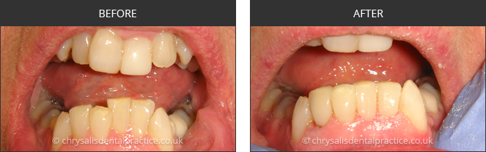 Gradia Smile Transformations at chrsalis dental practice, bedford dental practice