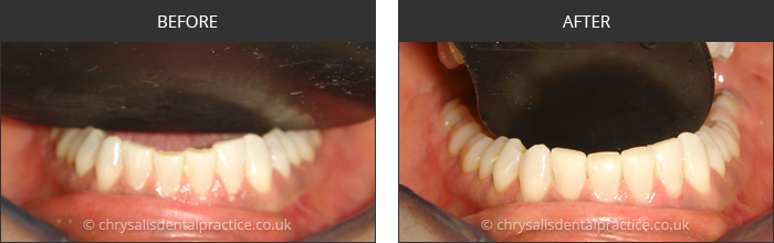 Gradia Smile Transformations at chrsalis dental practice, bedford dental practice