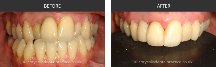 Gradia Smile Transformations at chrsalis dental practice, bedford dental practice