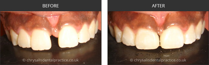 Gradia Smile Transformations at chrsalis dental practice, bedford dental practice