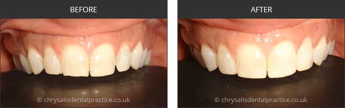 Gradia Smile Transformations at chrsalis dental practice, bedford dental practice