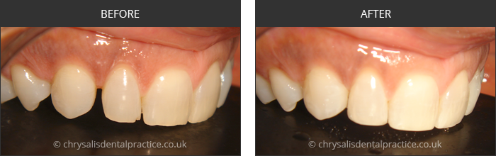 Gradia Smile Transformations at chrsalis dental practice, bedford dental practice