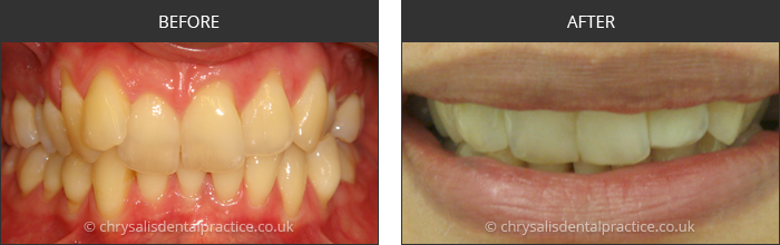 Gradia Smile Transformations at chrsalis dental practice, bedford dental practice