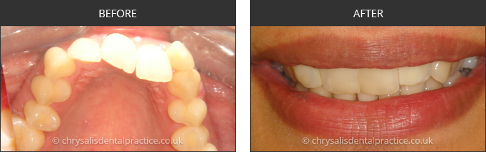 Gradia Smile Transformations at chrsalis dental practice, bedford dental practice