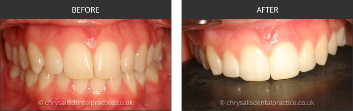 Gradia Smile Transformations at chrsalis dental practice, bedford dental practice