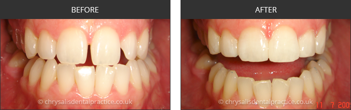 Gradia Smile Transformations at chrsalis dental practice, bedford dental practice