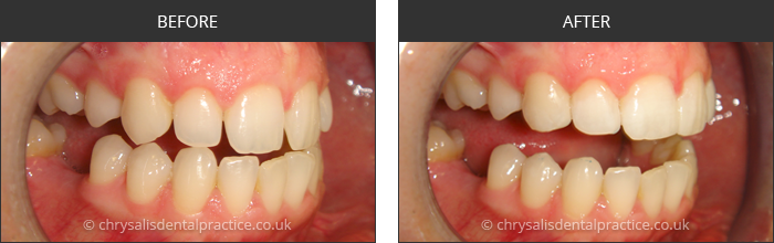 Gradia Smile Transformations at chrsalis dental practice, bedford dental practice