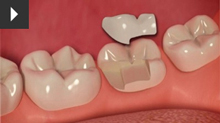 Inlays and onlays at chrysalis dental practice in bedford practice