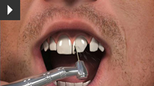 crown treatment showcase at chrsalis dental practice, bedford dental practice