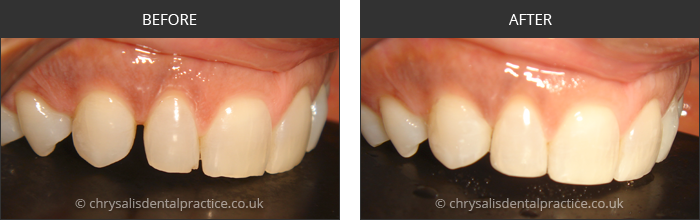 Gradia Smile Transformations