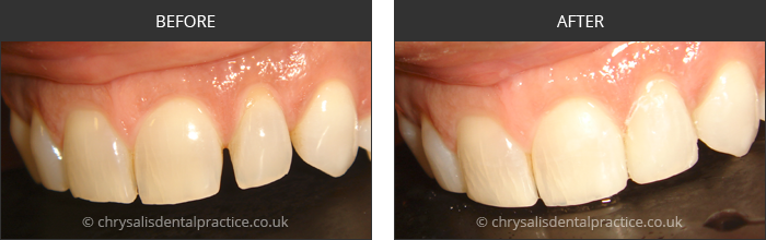 Gradia Smile Transformations