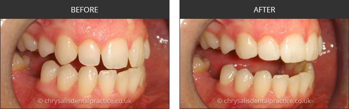 Gradia Smile Transformations